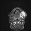 Axial MRI T1W with Gd and Fat Saturation of the jaw - Lt Osteosarcoma 00
