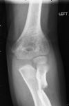 proximal radius fracture in child