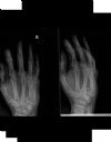 4th adn 5th metacarpal fractures. Radiograph. Courtesy of www.healthengine.com.au