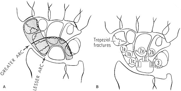 Arcs of the Wrist (A) & progression of carpal injury (B)