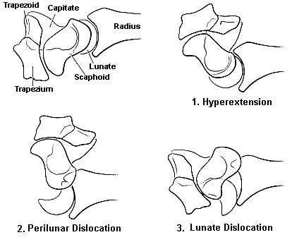 Prograssion of Lesser Arc Injury